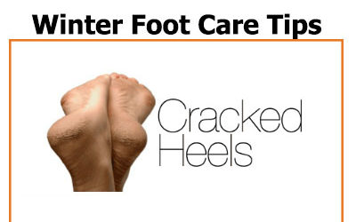Feb 2020 Newsletter – Winter Foot Care: Tips for Cracked Heels and more