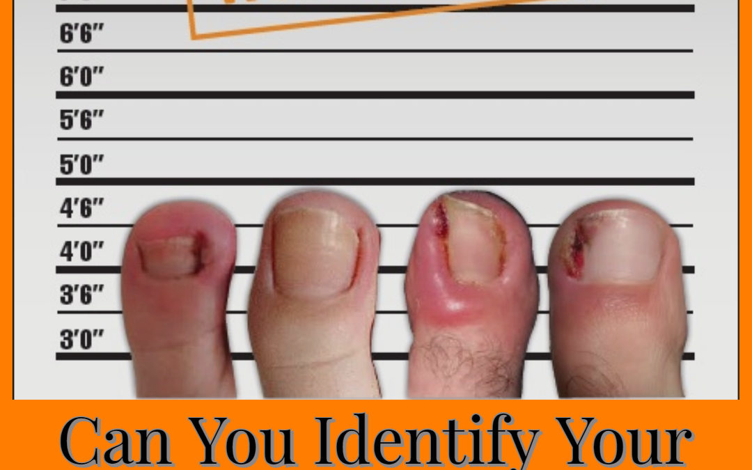 Can you identify your ingrown toenail culprit?