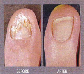 toe with versus without toenail fungus
